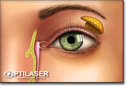 Clinica de ojos Optilaser - Obstruccion